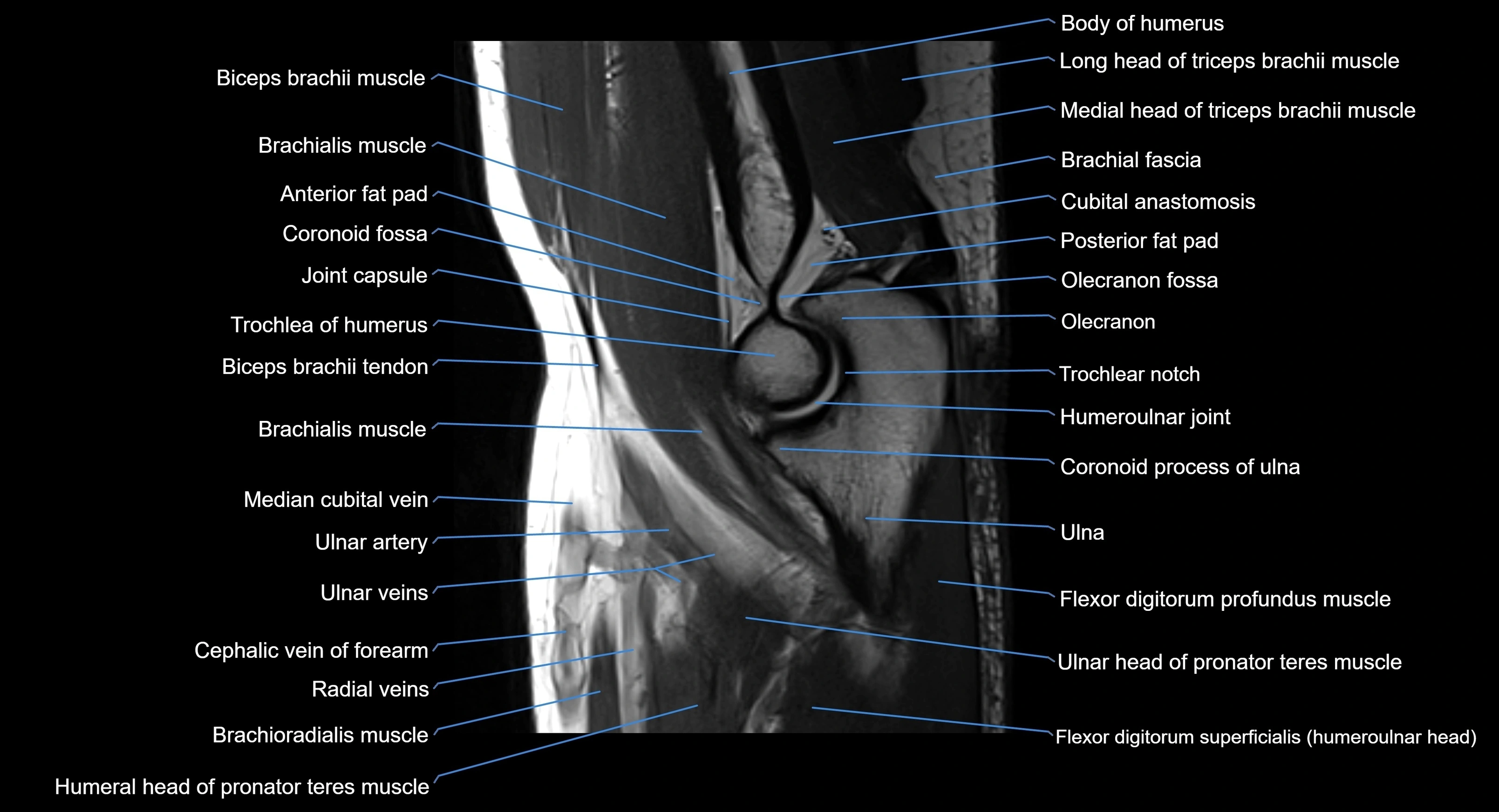 MRI elbow joint  sagittal cross sectional anatomy 3T  radiology  image-img-00001-00013.webp